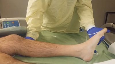 Ankle Clonus in person with spinal cord injury