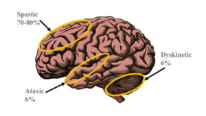 seating dynamics blog diagnoses characterized by increased muscle tone