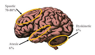 seating dynamics cerebral palsy brain diagram